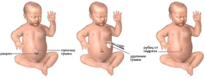 hernie ombilicala la sugari Cauzele și tratament (hernie) hernie ombilicala la sugari cauzele și tratament