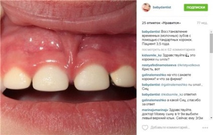 4 copii dinți superiori putrezit (copil) 4 copii dinți superiori putrezit