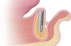 Recomandări după implantarea dinților (dinți după implantare) Recomandări dinți după implantare