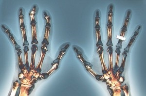simptomele artritei reumatoide și tratamentul seropozitiva (reumatoide) simptomele artritei reumatoide și tratamentul seropozitiv