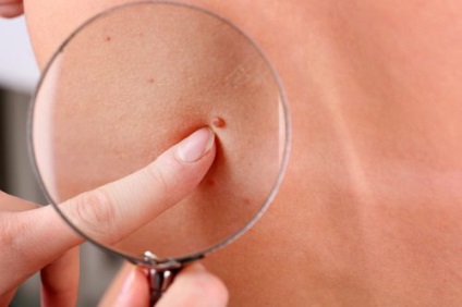 Mole scoate peroxid în casă, utilizarea de droguri (mol) Mole scoate peroxid în casă, utilizarea de droguri