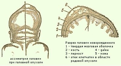 Umflarea pe scalp în cauze nou-nascuti si tratament (nou-născuți) Umflarea pe scalp în cauze nou-născuți și tratament