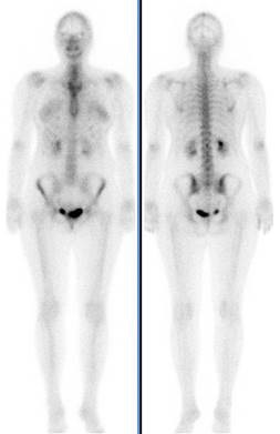 Bucuresti Cercetare Ftiziopneumologie - diagnostic radionuclid a sistemului osos (diagnosticare) Bucuresti Cercetare Ftiziopneumologie - diagnostic radionuclid a sistemului osos