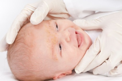 Exfolierea scalpului la sugari (grudnichka) Exfolierea scalpului la sugari