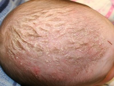 Exfolierea scalpului la sugari (piele) Exfolierea scalpului la sugari