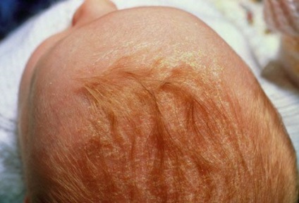 Exfolierea scalpului la sugari (cap) Exfolierea scalpului la sugari