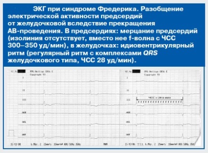 Sindromul Frederick - cauze, simptome si tratament (tratament) Sindromul Frederick - cauze, simptome și tratament