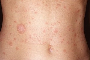 Erupție pe stomacul unui adult (adult abdominal rash) Erupții cutanate pe stomacul unui adult