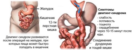 Slăbiciune dupa masa (dupa masa produsului alimentar) Slăbiciune dupa masa