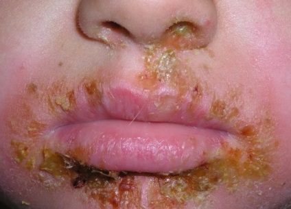 Simptomele Strep impetigo, cauze, diagnostic, tratament (tratament impetigo strep) simptome Strep impetigo, cauze, diagnostic, tratament