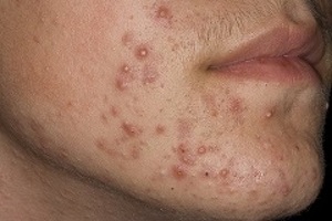 Simptomele Strep impetigo, cauze, diagnostic, tratament (impetigo) simptome Strep impetigo, cauze, diagnostic, tratament
