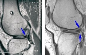 prejudiciu meniscal (meniscului articulației genunchiului) prejudiciu meniscului
