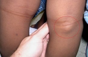 prejudiciu meniscal (meniscului articulației genunchiului) prejudiciu meniscului