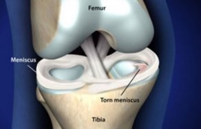 prejudiciu meniscal (meniscului articulației genunchiului) prejudiciu meniscului