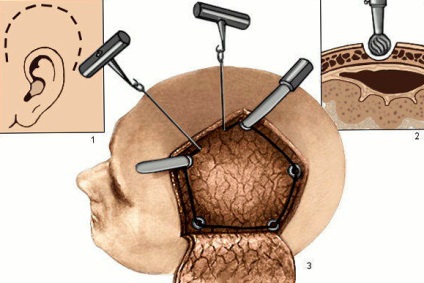 Efecte accident vascular cerebral craniotomie (craniană) Efecte accident vascular cerebral craniotomie