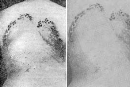 Sifilisul terțiar (terțiar sifilis gomă syphilide perioada târzie foto) terțiar