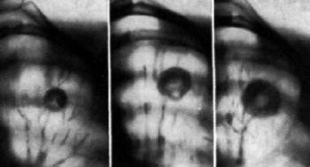 Tuberculoma lumina-l și consecințele (consecințele) Tuberculoma-l și consecințele lumină