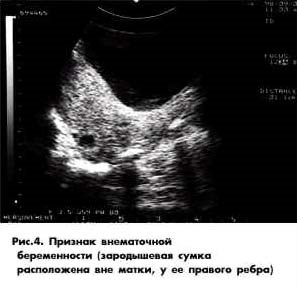 Diagnostic cu ultrasunete de sarcină ectopică (diagnosticare cu ultrasunete) Diagnostic cu ultrasunete de sarcină ectopică