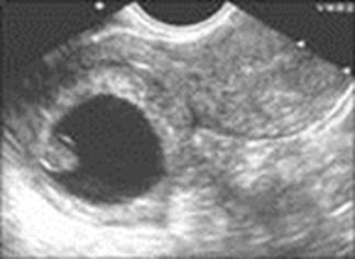Diagnostic cu ultrasunete de sarcină ectopică (diagnostic) Diagnostic cu ultrasunete de sarcină ectopică