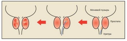 Exerciții pentru prevenirea prostatita - un mod eficient de a evita boala (Asigurați abordare fiecare) Exerciții pentru prevenirea prostatita - un mod eficient de a evita boli