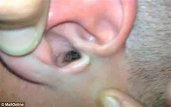 ureche acarieni la oameni, care este un risc si tratament, dezinfectie si deratizare - (persoana) ureche acarieni la oameni, care este un risc si tratament, dezinfectie si deratizare -