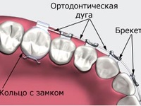 Aparatul de bretele (blocare arc ortodontic) acolade Apparatus