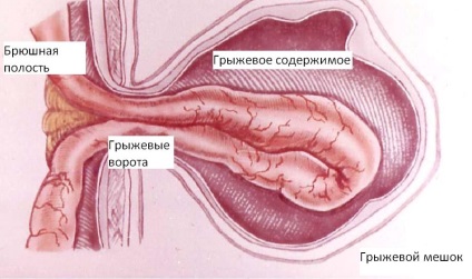 Tipuri de dureri de hernie inghinala (inghinala) Tipuri de dureri de hernie