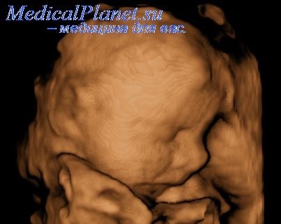 malformații congenitale ale creierului (congenital) malformații congenitale ale creierului