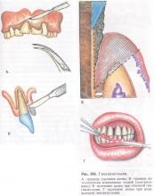 Tratamentul chirurgical, boala parodontală și periodontita, tratamentul bolilor parodontale (parodontale) Tratamentul chirurgical, boala parodontală și periodontita, tratamentul bolilor parodontale