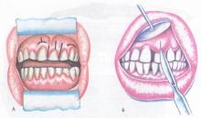 Tratamentul chirurgical, boala parodontală și periodontita, tratamentul bolii parodontale (parodontoza) Tratamentul chirurgical, boala parodontală și periodontita, tratamentul bolilor parodontale