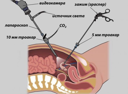 endometrioza cronica - ceea ce este, simptomele si tratamentul (cronic) Cronica endometrioza - ceea ce este, simptome și tratament