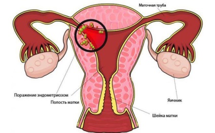 endometrioza cronica - ceea ce este, simptome și tratament (tratament) Cronica endometrioza - ceea ce este, simptome și tratament