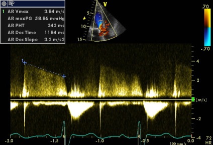 Anny anevrism ruptura sinusului coronarian drept de Valsalva fistulei in pancreas