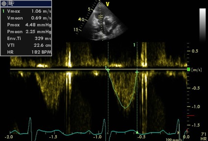 Anny anevrism ruptura sinusului coronarian drept de Valsalva fistulei in pancreas