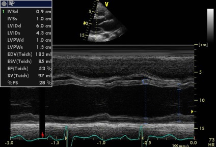 Anny anevrism ruptura sinusului coronarian drept de Valsalva fistulei in pancreas