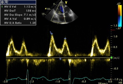 Anny anevrism ruptura sinusului coronarian drept de Valsalva fistulei in pancreas