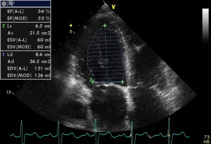 Anny anevrism ruptura sinusului coronarian drept de Valsalva fistulei in pancreas