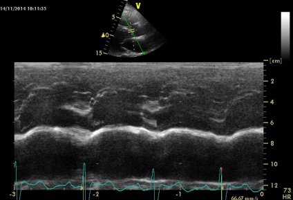 Anny anevrism ruptura sinusului coronarian drept de Valsalva fistulei in pancreas