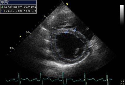 Anny anevrism ruptura sinusului coronarian drept de Valsalva fistulei in pancreas