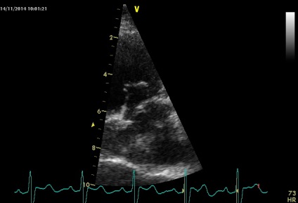 Anny anevrism ruptura sinusului coronarian drept de Valsalva fistulei in pancreas