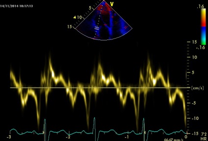 Anny anevrism ruptura sinusului coronarian drept de Valsalva fistulei in pancreas