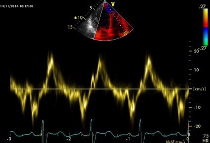 Anny anevrism ruptura sinusului coronarian drept de Valsalva fistulei in pancreas