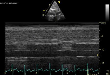 Anny anevrism ruptura sinusului coronarian drept de Valsalva fistulei in pancreas