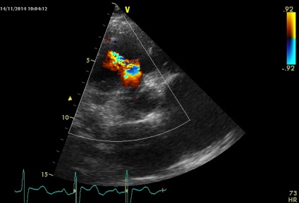 Anny anevrism ruptura sinusului coronarian drept de Valsalva fistulei in pancreas