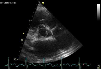 Anny anevrism ruptura sinusului coronarian drept de Valsalva fistulei in pancreas