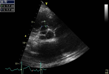 Anny anevrism ruptura sinusului coronarian drept de Valsalva fistulei in pancreas