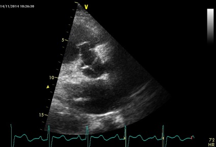 Anny anevrism ruptura sinusului coronarian drept de Valsalva fistulei in pancreas