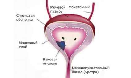 Boli ale vezicii urinare la femei Diagnostic, simptome, tratament