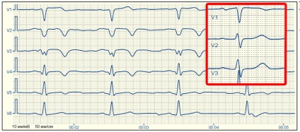 cicatrici E-cardio