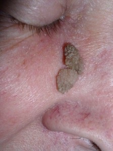 Distingându de la mol papilloma (mol) Cum să se facă distincția mol de papiloma
